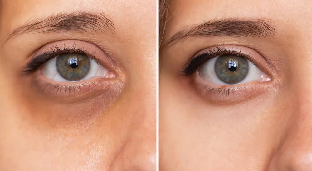 Remove Dark Circles Permanently