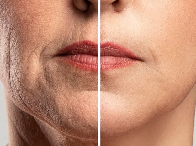 Say Good Bye to Wrinkles and Fine lines